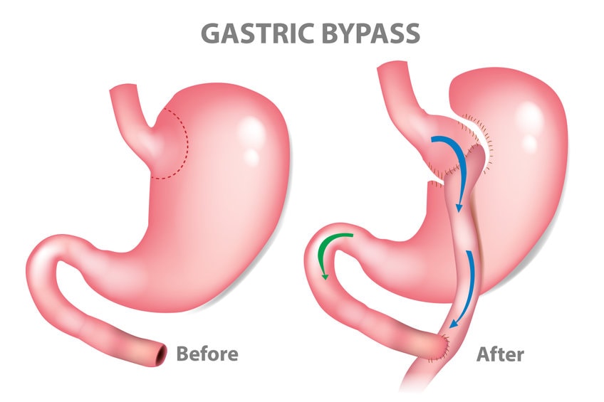 Afvallen na een gastric bypass